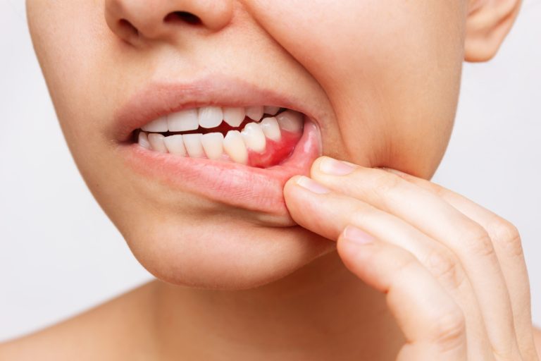 What Causes Bleeding Gums?