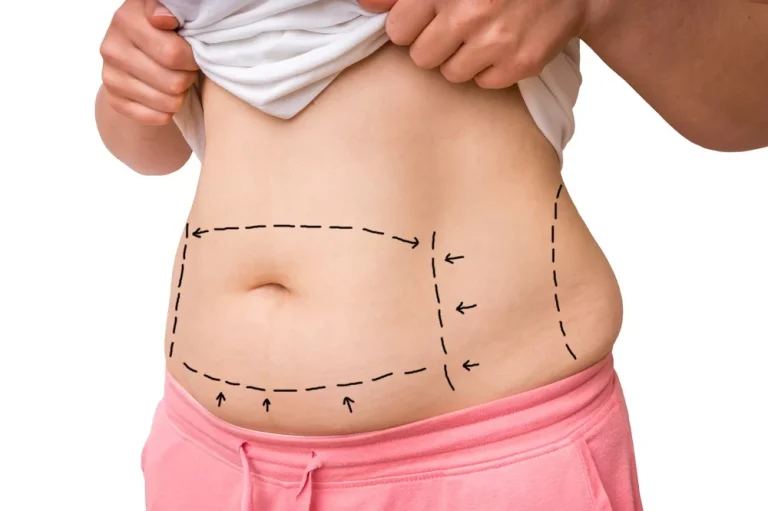 How Abdominoplasty Can Improve Physical Health and Mobility